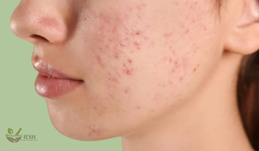 Acne Scars Removal Treatment at Iesh Ayurveda Skin Clinic Thrissur