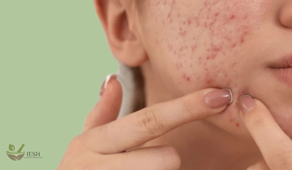 Acne Scars Treatment at Iesh Ayurveda Thrissur
