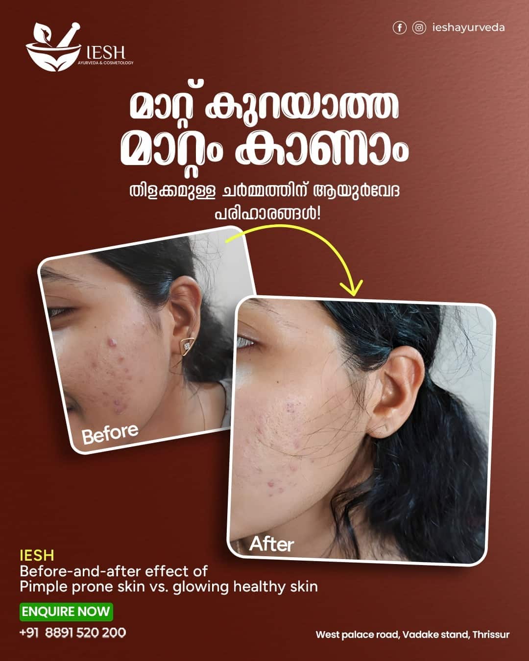 Anti Acne Treatment at Iesh Ayurveda Skin Clinic Thrissur- Before and After Results 2025