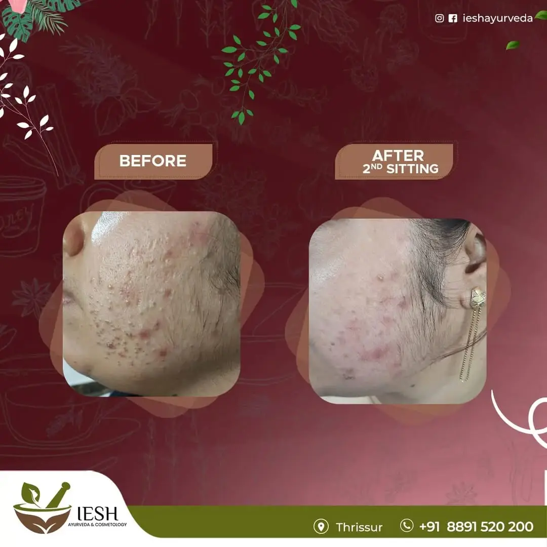 Anti Acne Treatment at Iesh Ayurveda Skin Hospital Thrissur- Before and After Results 2025