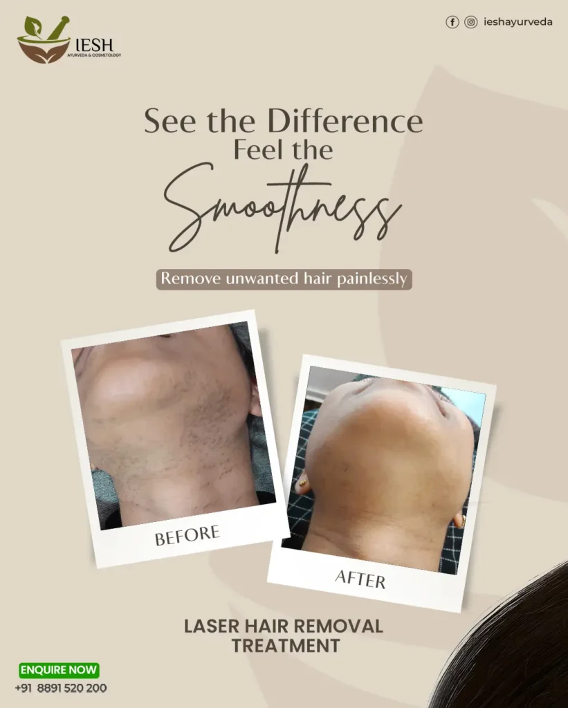 Laser Hair Removal Treatment 48 Let your skin shine the way it deserves! Our laser hair removal treatment gives you lasting results without pain