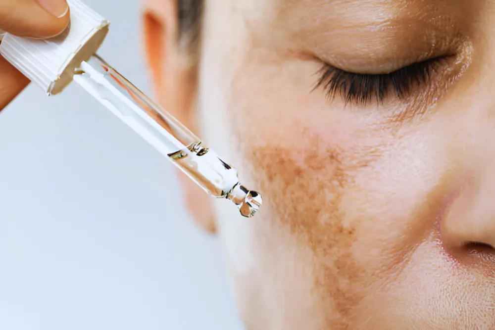 Anti-Melasma Treatment in Thrissur 6 Anti-Melasma Treatment in Thrissur