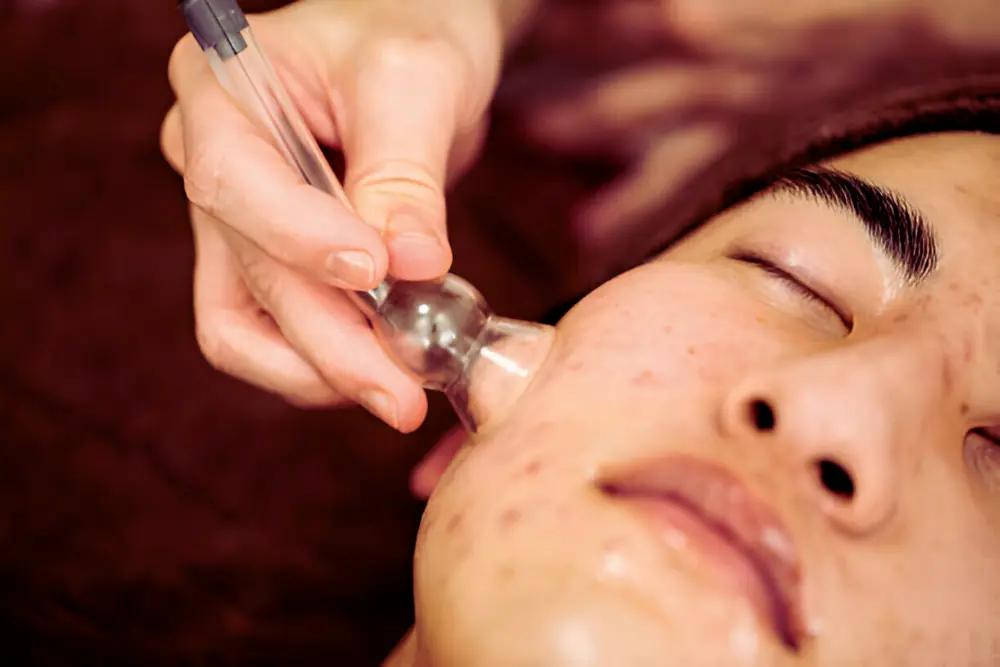 Cupping Collagen Therapy 11 Cupping Collagen Therapy in Thrissur