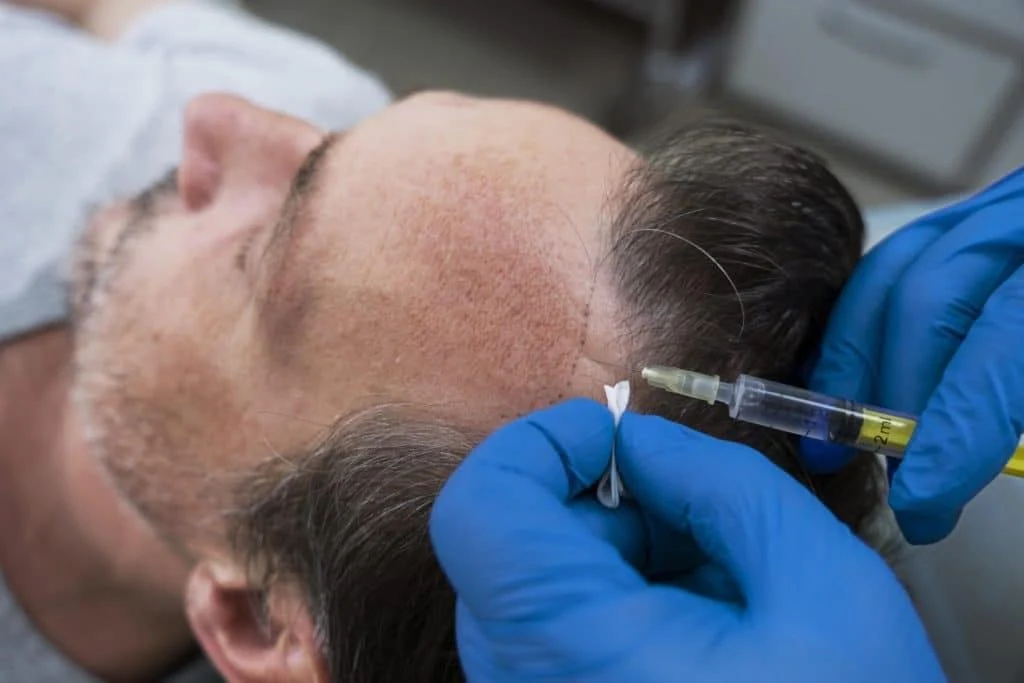 Microneedling for hair