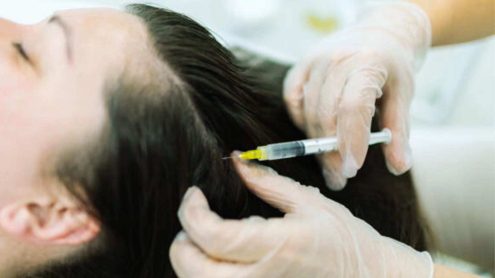 Hair Mesotherapy in Thrissur 6 Hair Mesotherapy in Thrissur