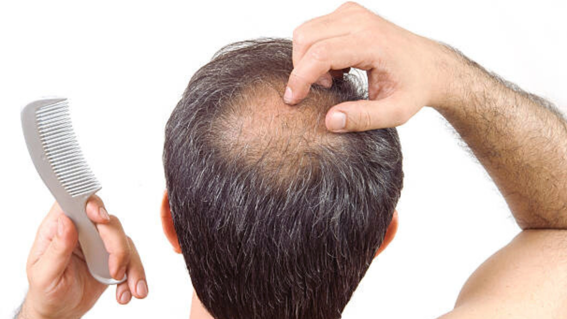 How to Prevent Crown Hair Loss: Best Tips for Stronger, Thicker Hair!