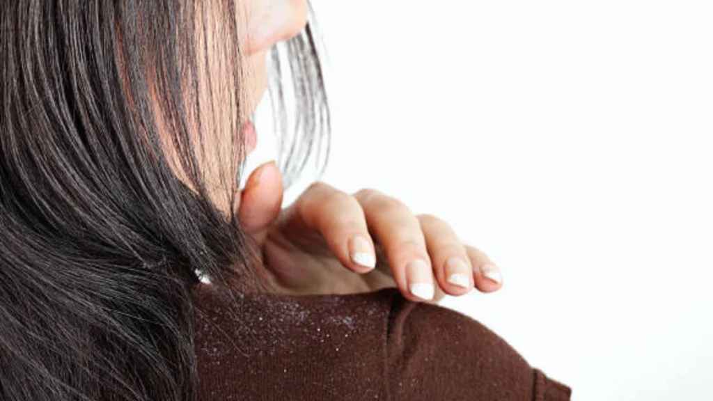 Hair Care Routine For Dandruff