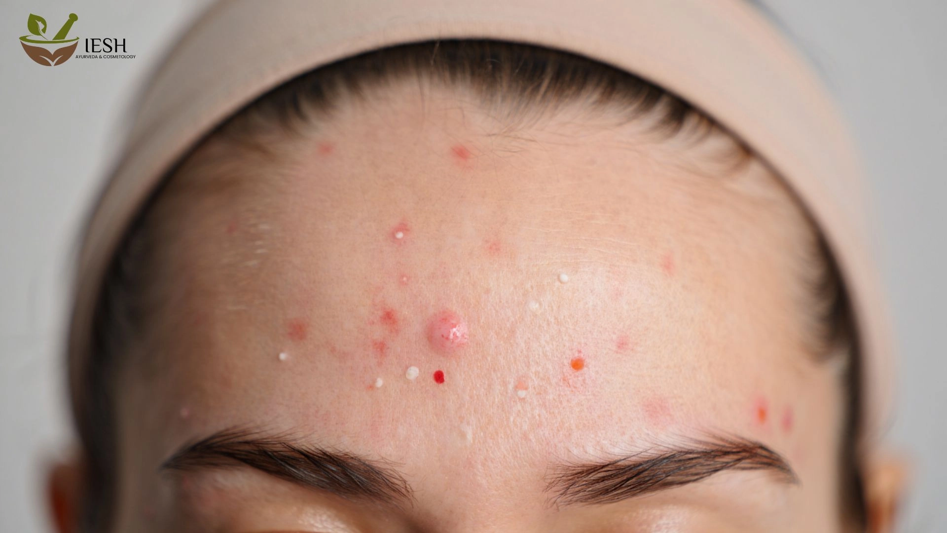 How to Avoid Pimples on Forehead: Simple Tips for Clear and Healthy Skin!