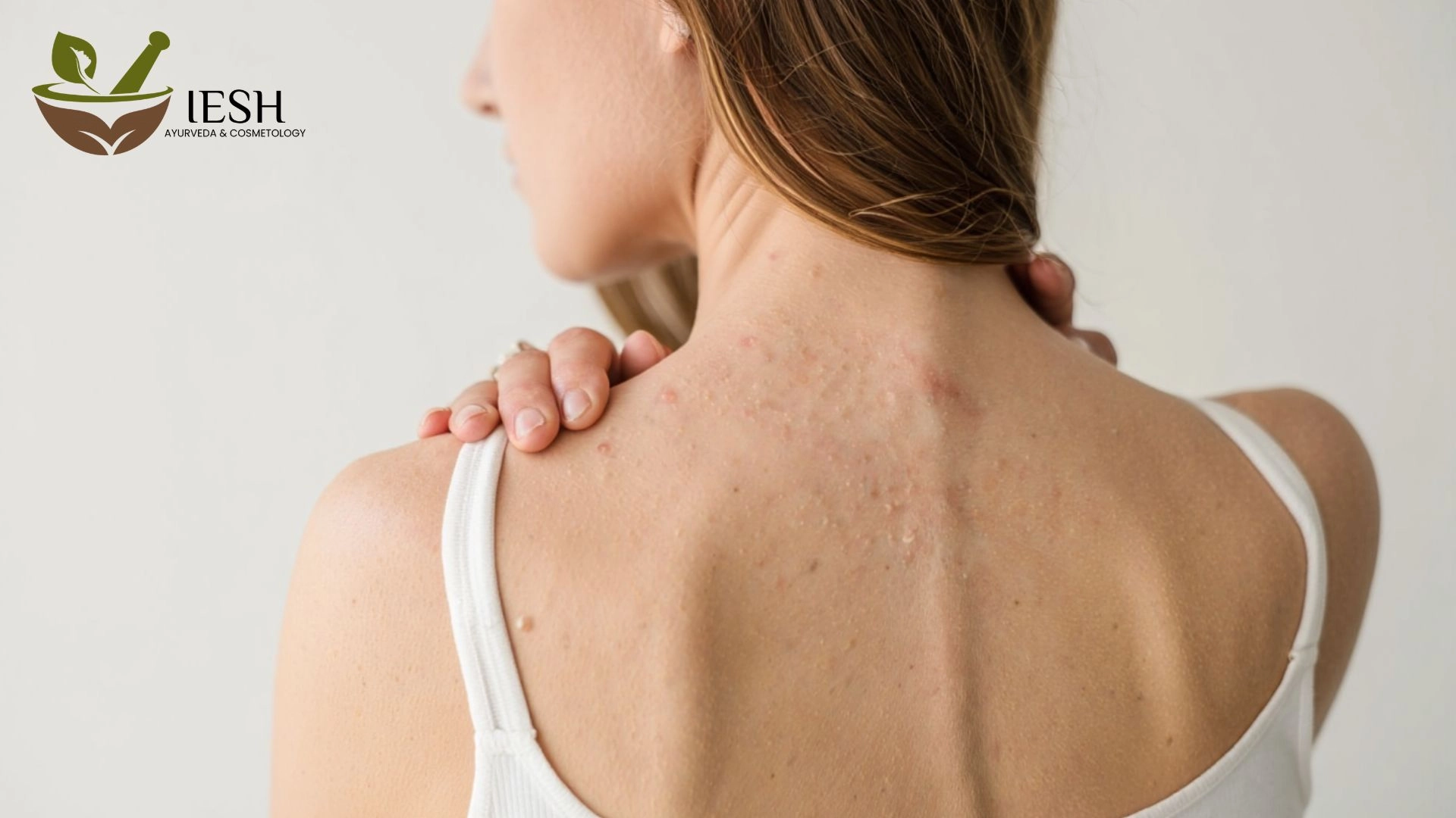 What Causes Back Acne in Females? Understanding the Triggers and Effective Solutions!