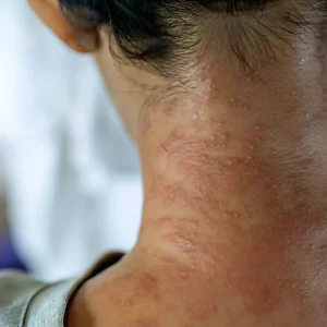 Blogs 32 Ayurvedic Treatment For Skin Diseases in Kerala – A Valuable Guide!