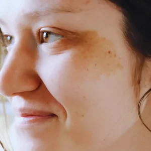 Best Treatments For Pigmentation