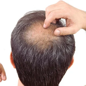 Prevent Crown Hair Loss