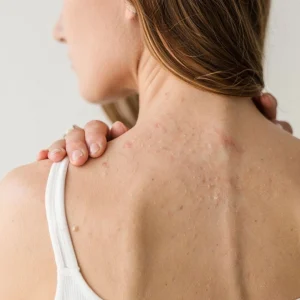 What Causes Back Acne in Females